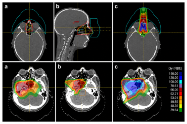 La imagen muestra cómo la protonterapia concentra la radiación en el tumor durante una reirradiación, preservando al máximo los tejidos sanos ya tratados.