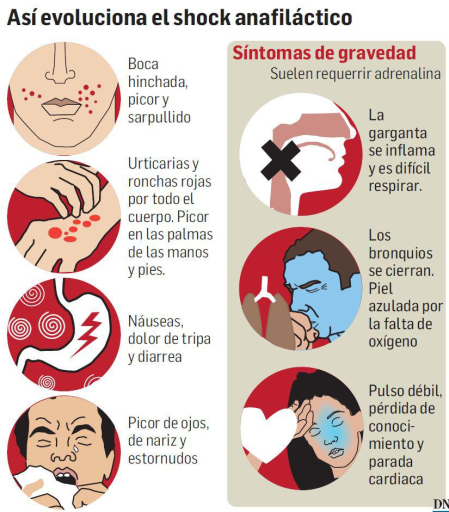 Así evoluciona el shock anafiláctico