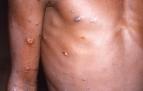 Pústulas que causa la viruela del mono en el cuerpo de una persona infectada en 1996 en la República Democrática del Congo