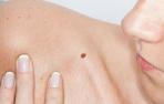 ​El melanoma avanzado, de "patito feo" a uno de los tumores con más opciones