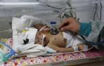Mueren por falta de atención médica dos bebés siameses yemeníes