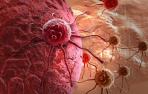 Células tumorales y de cáncer