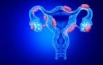 ENDOMETRIOSIS