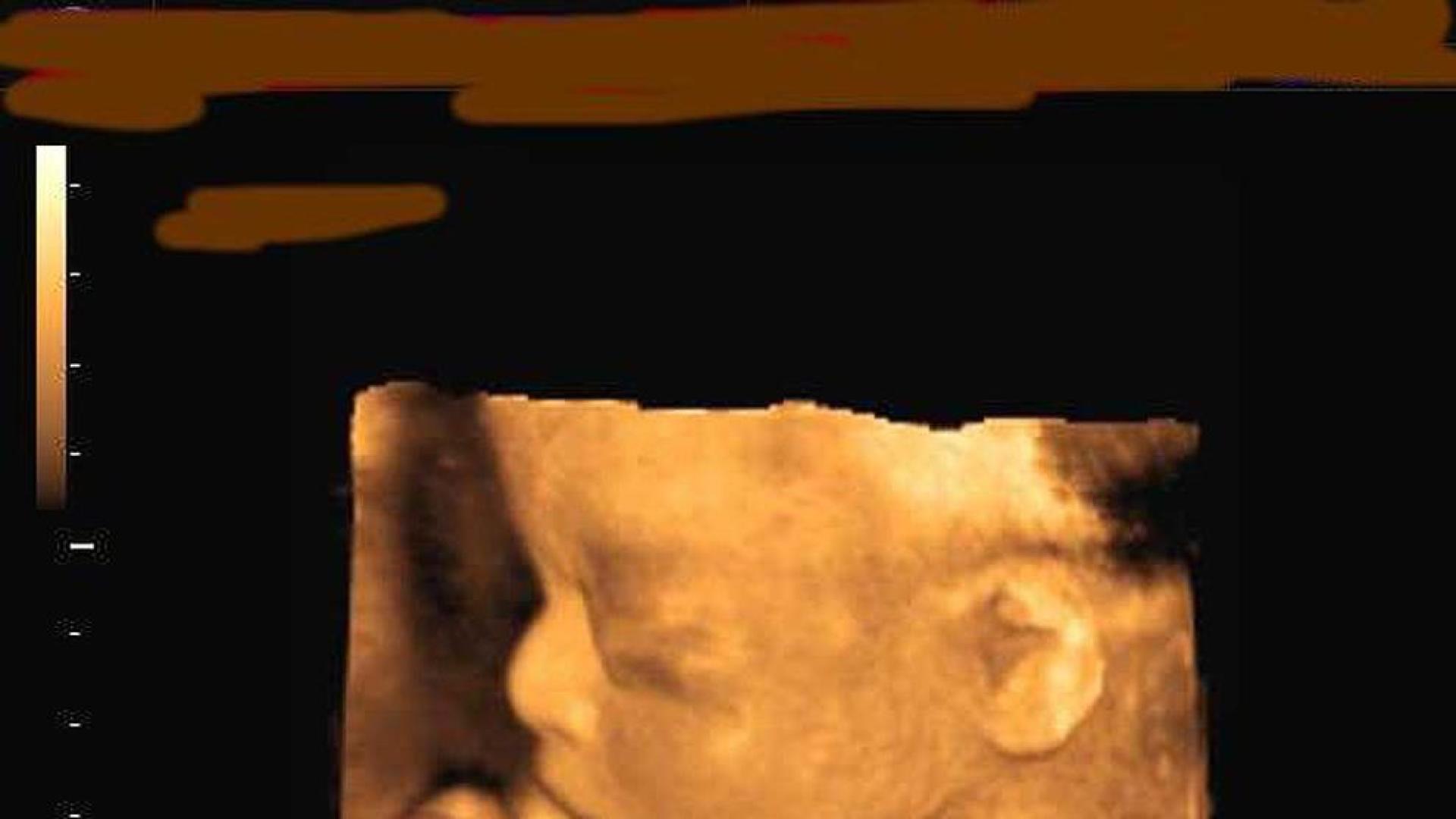 La medicina evoluciona para curar al feto antes de que nazca