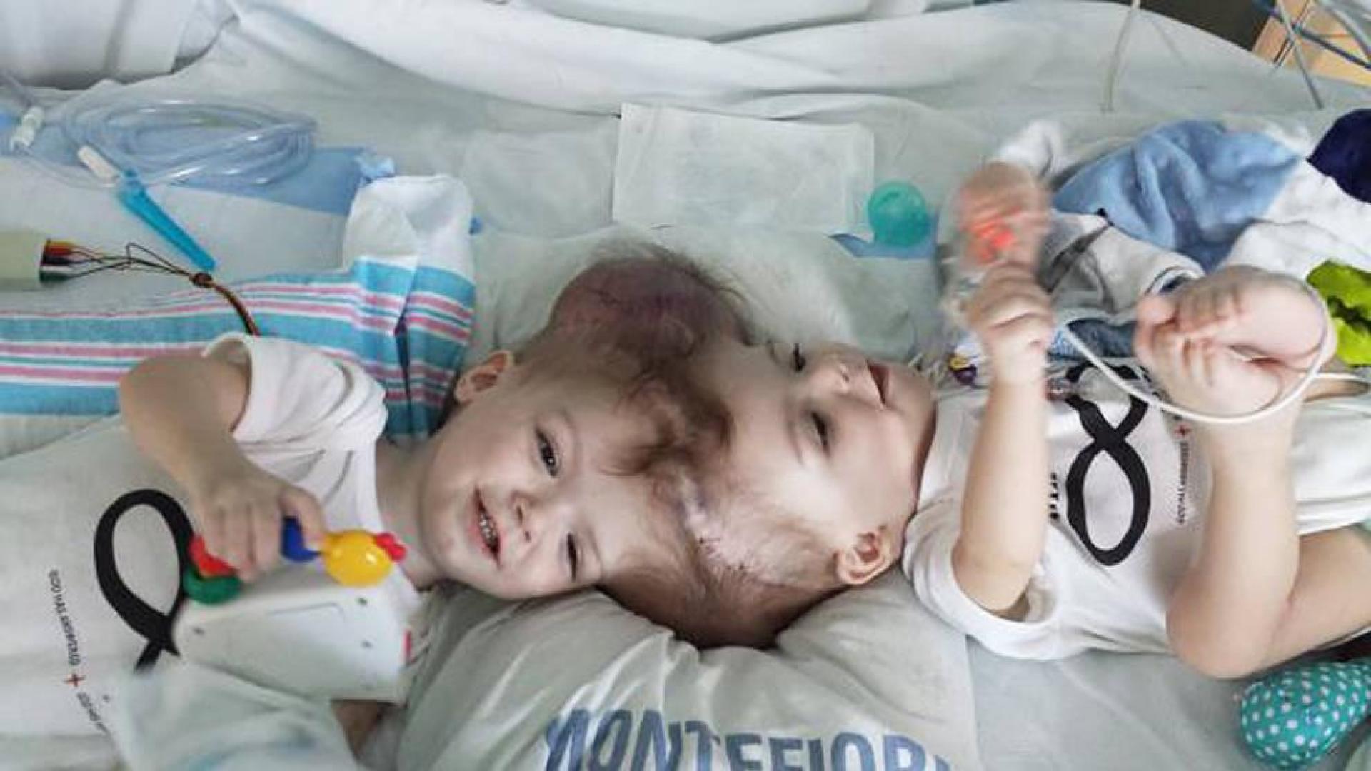 Separados con éxito dos gemelos siameses unidos por la cabeza