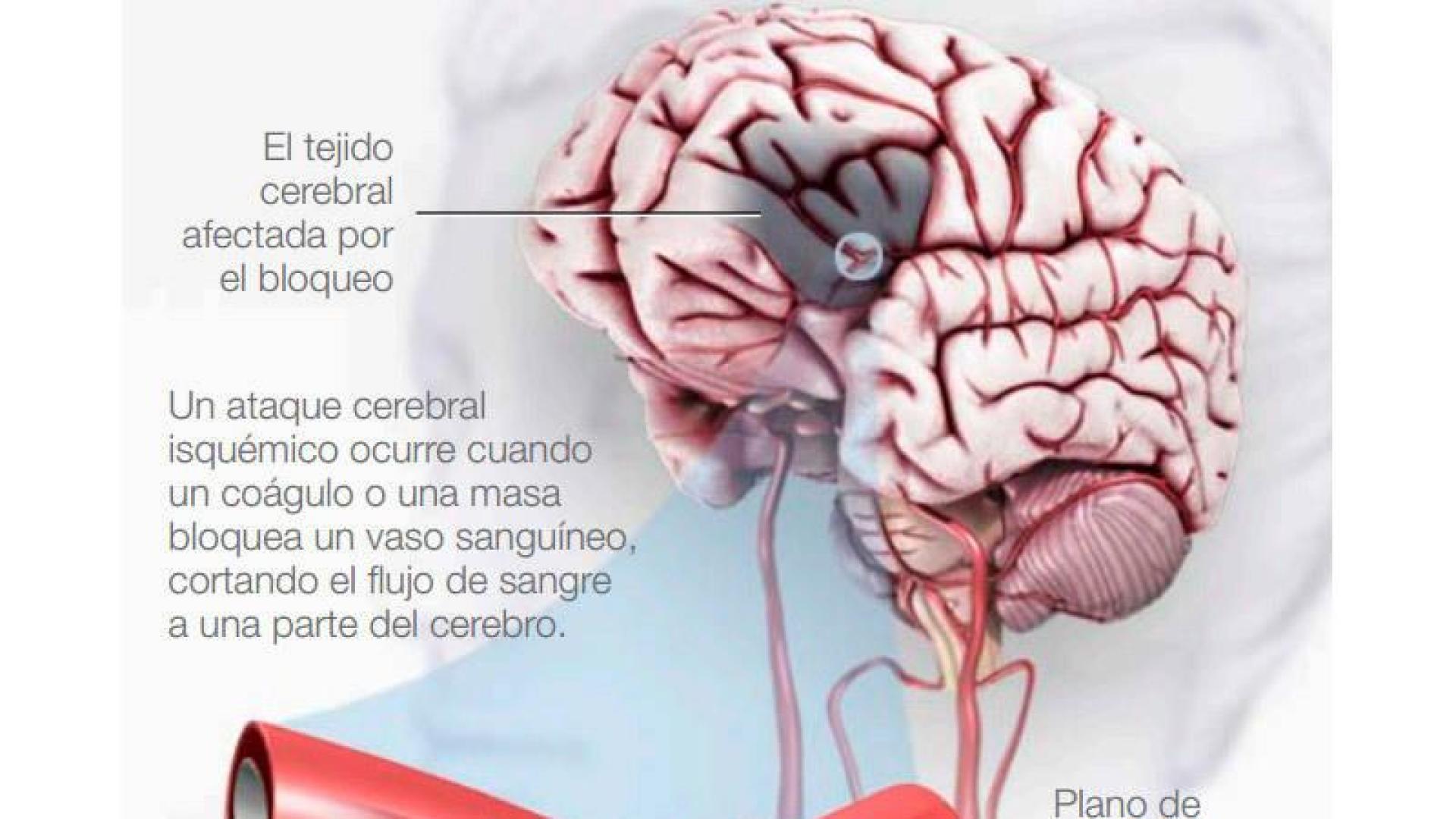¿Qué es una isquemia cerebral?