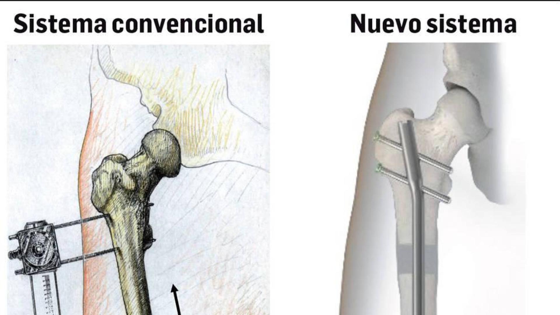 Un nuevo sistema permite alargar huesos sin fijadores externos