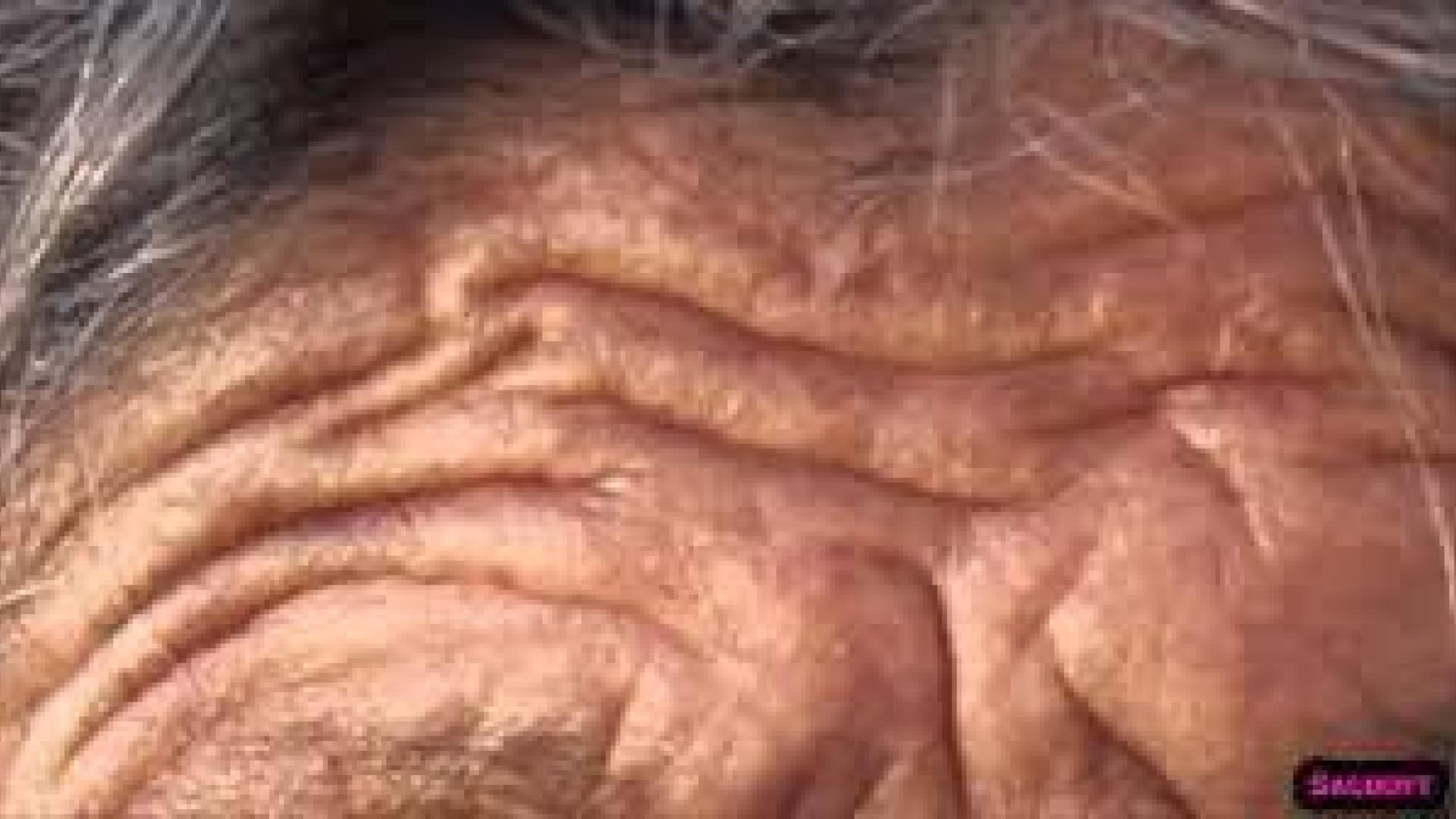 Los riesgos ocultos en las arrugas de la frente