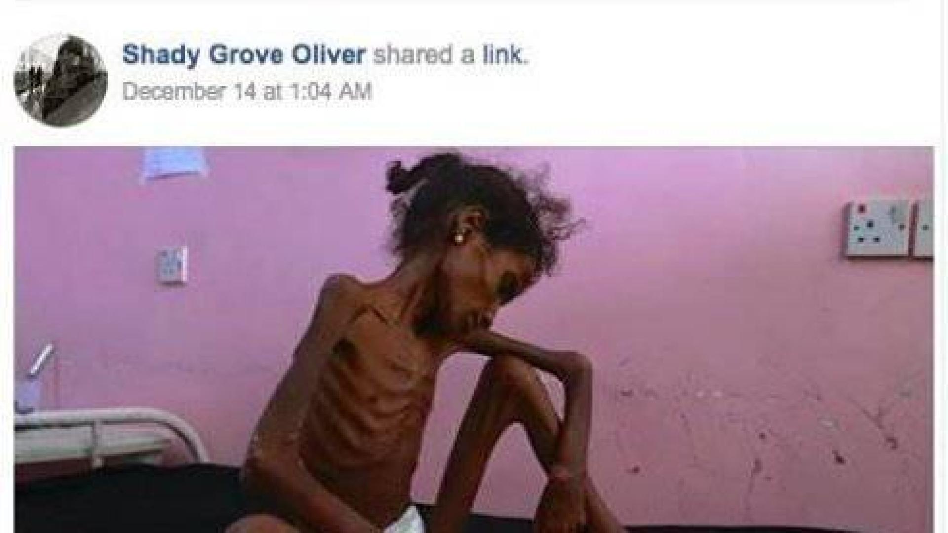 Facebook censura una foto del New York Times del hambre en Yemen por mostrar "desnudez"