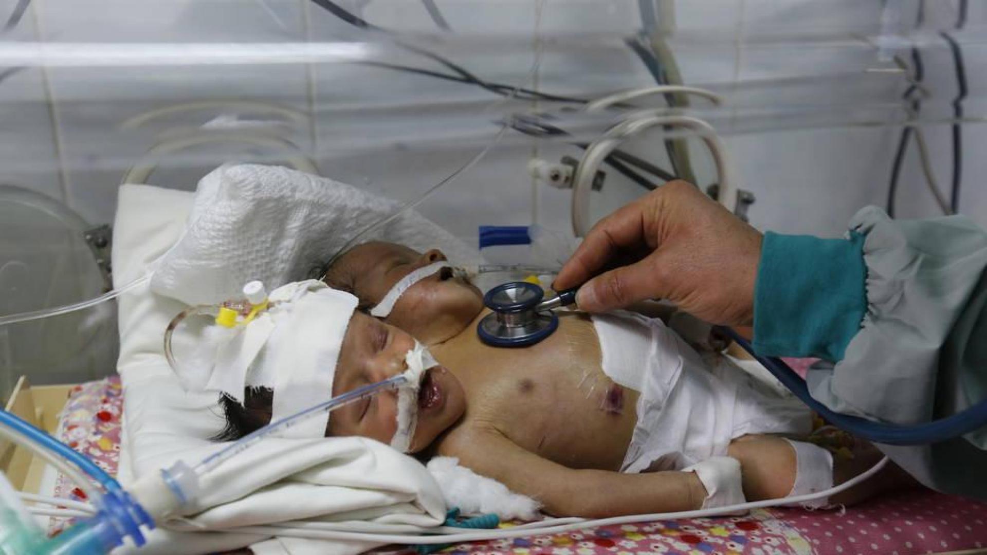 Mueren por falta de atención médica dos bebés siameses yemeníes