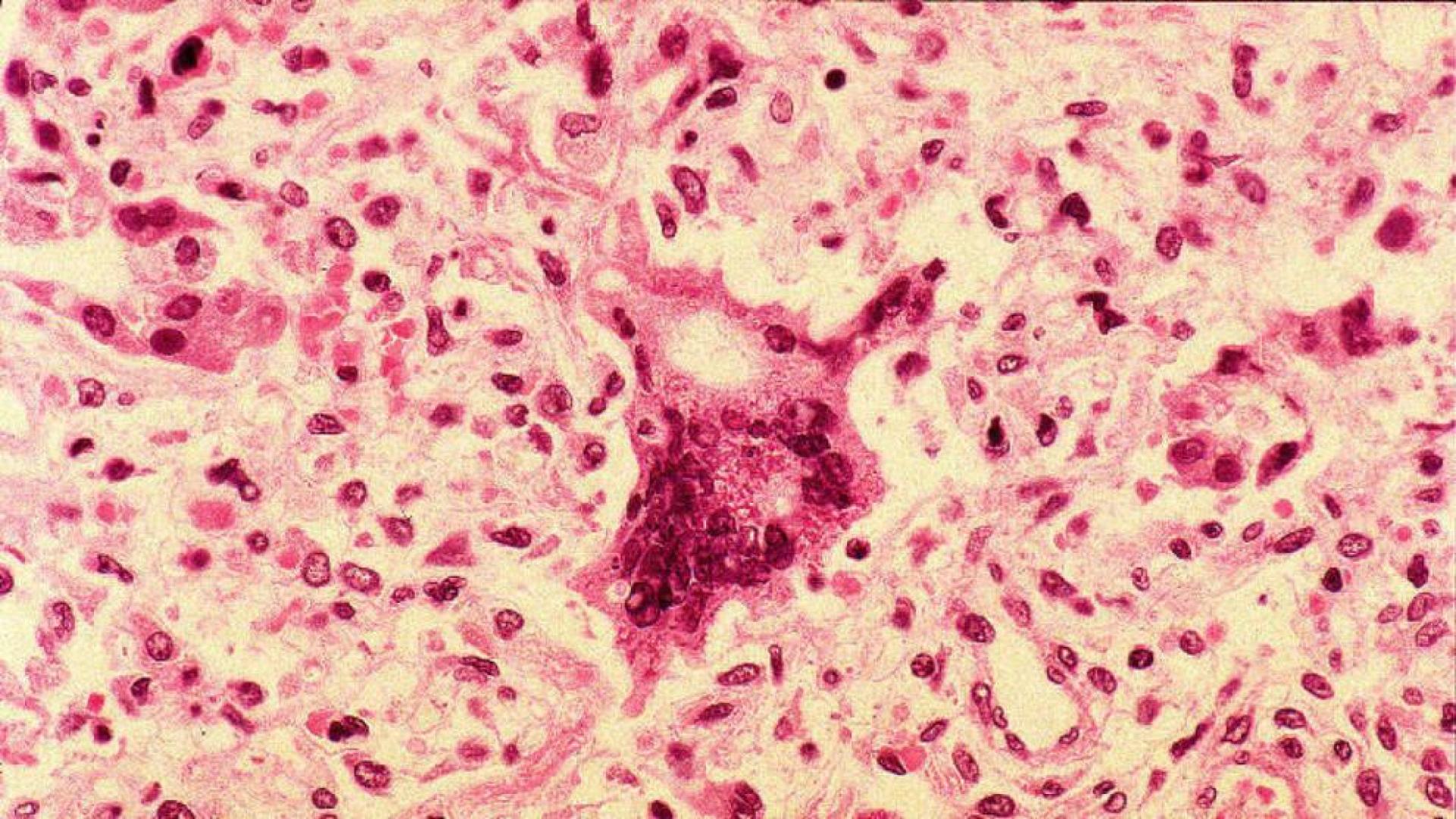 Alerta sanitaria por un caso de sarampión en una sidrería de Guipúzcoa