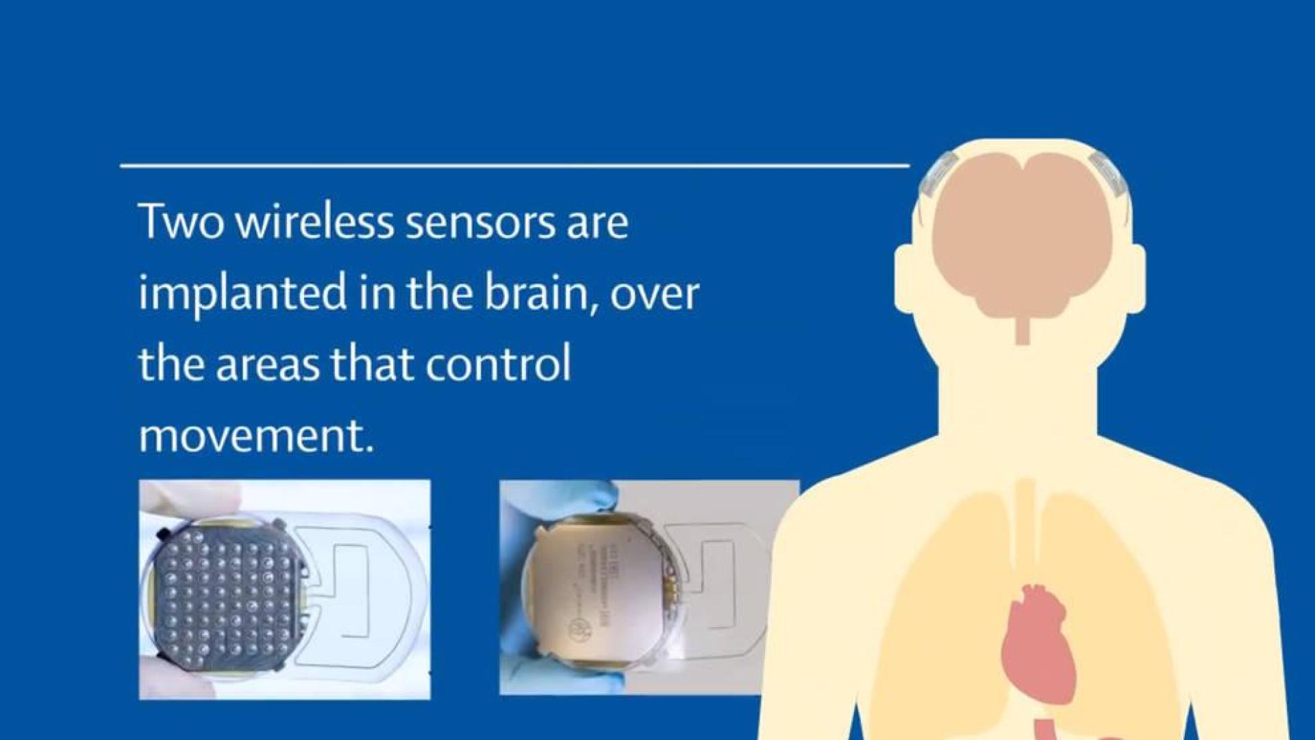 El exoesqueleto para tetrapléjicos controlado por el cerebro, cerca de ser realidad