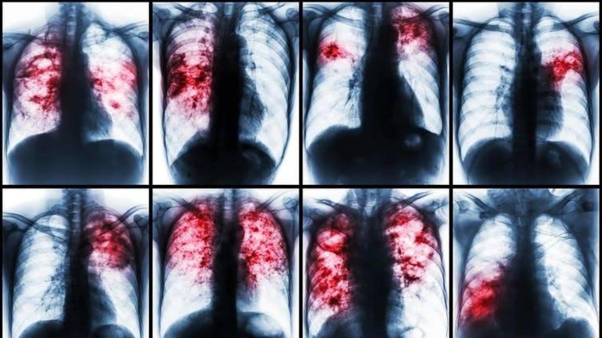 La pandemia de covid-19 amenaza la lucha contra la tuberculosis