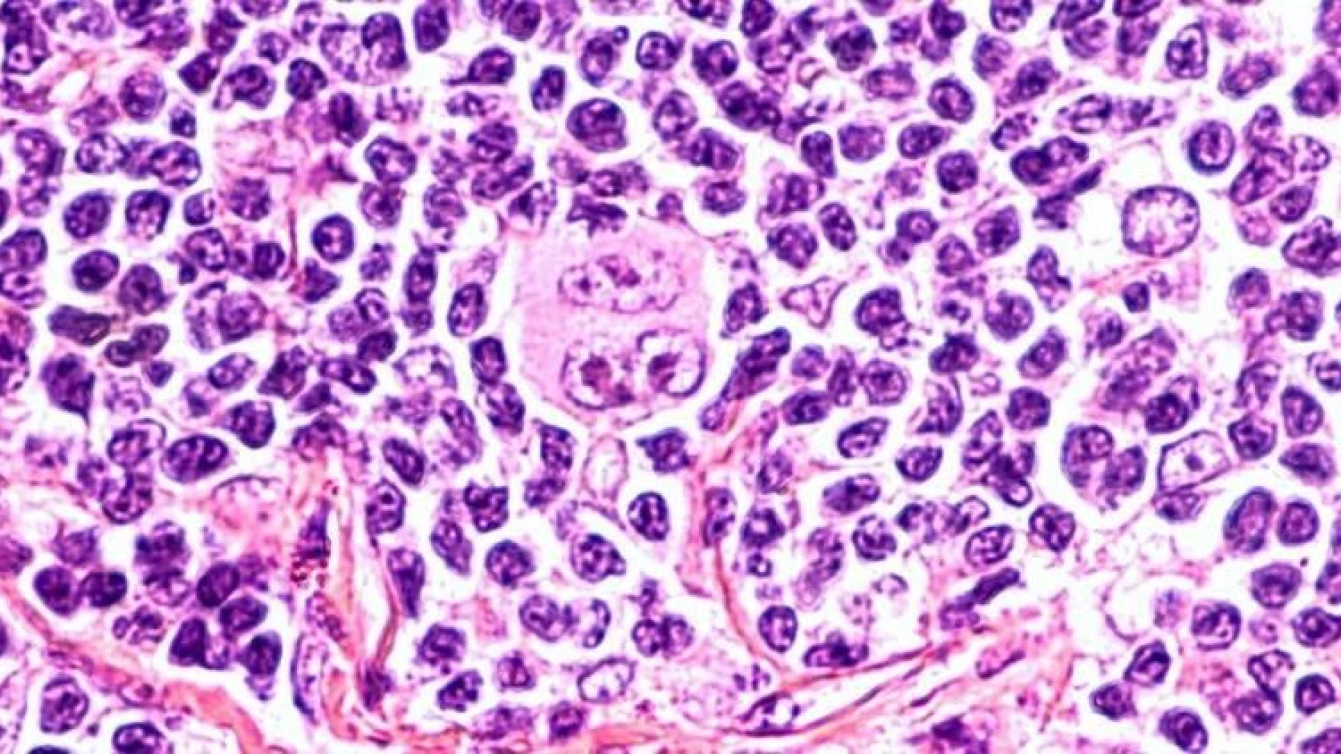 El extraño caso de la curación de un linfoma de Hodgkin por el coronavirus