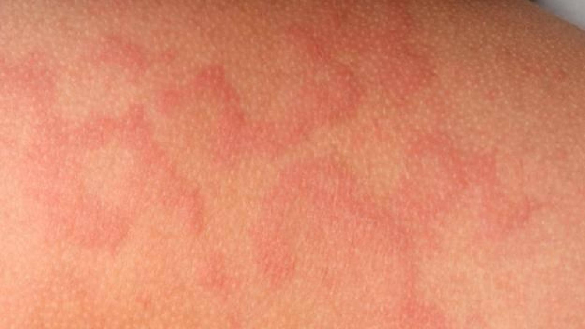 Alerta sanitaria por un caso de sarampión en una sidrería de Guipúzcoa