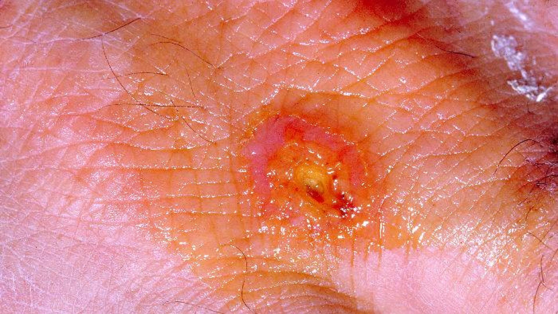 Piel afectada por tularemia
