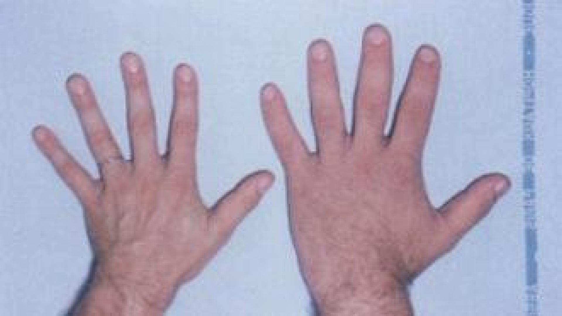Mano con acromegalia