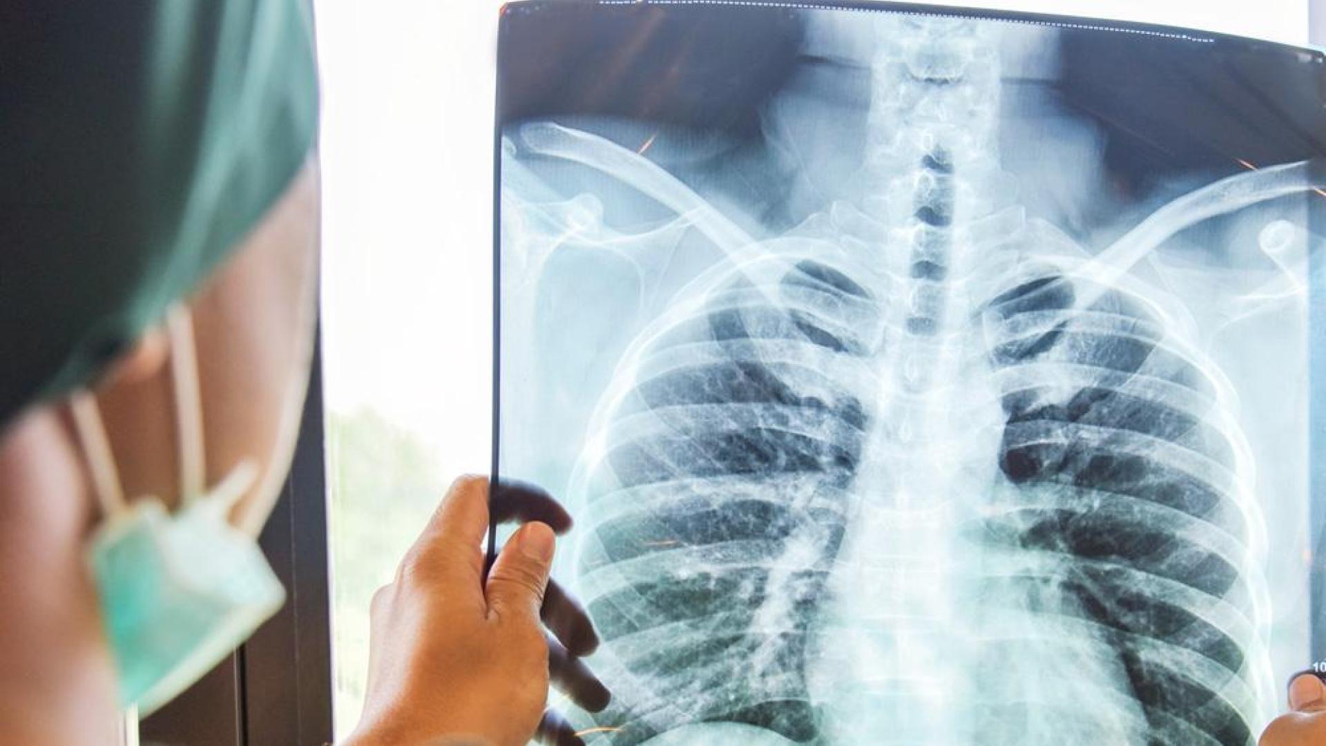 Tuberculosis