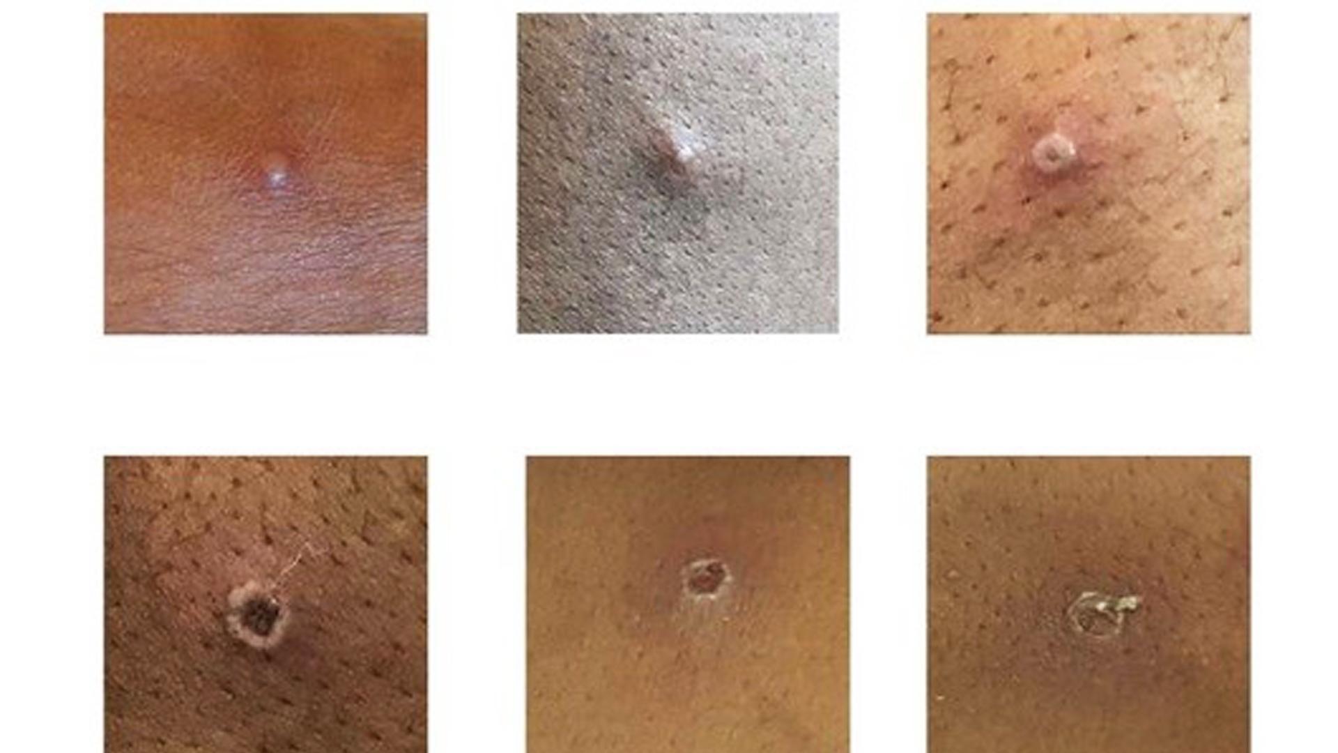 Pústulas en la piel de personas infectadas por la viruela del mono