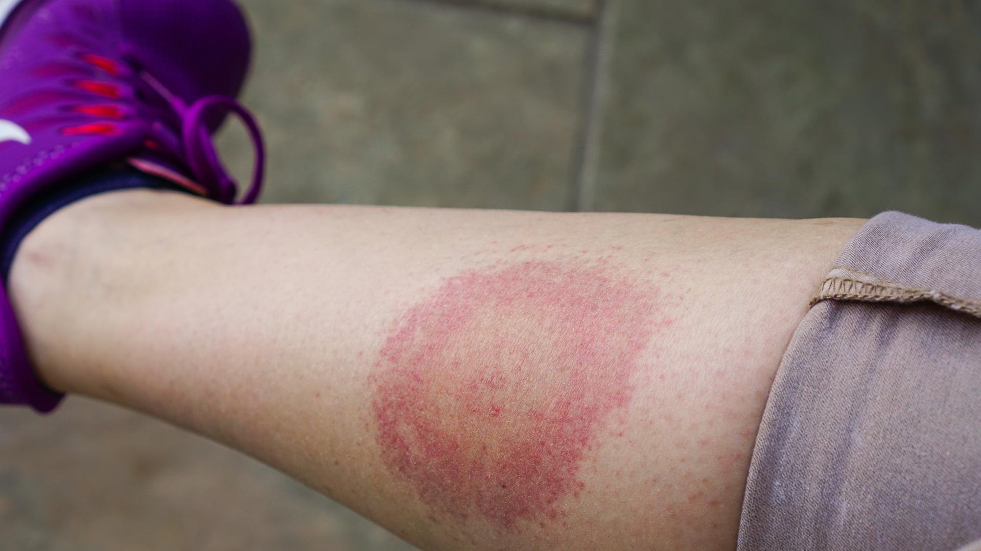 La enfermedad de Lyme es transmitida por la picadura de garrapatas infectadas