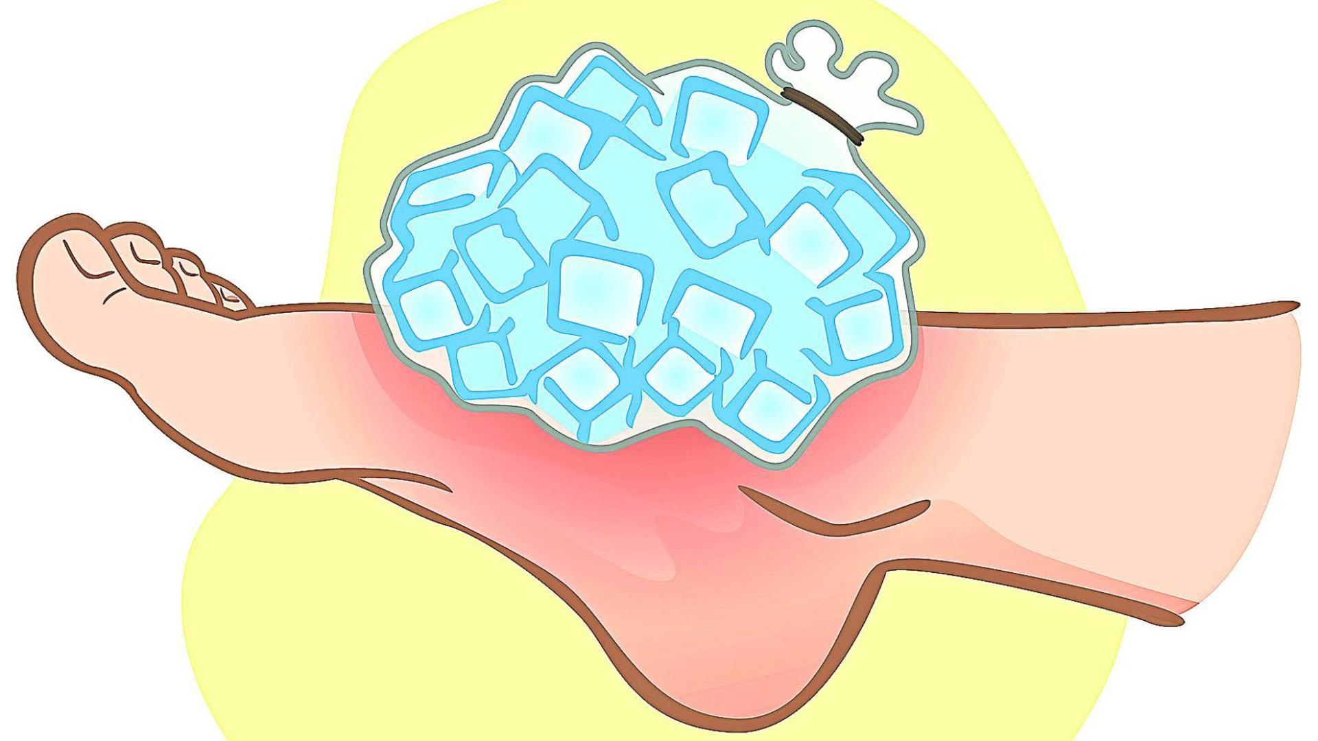 Ilustración de un pie lesionado tratado con hielo