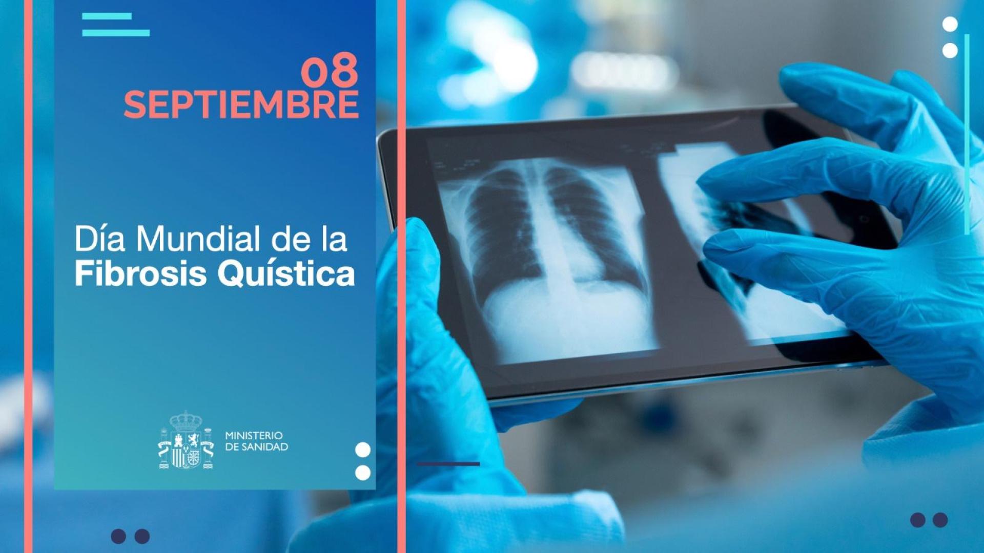 Día Mundial de la Fibrosis Quística