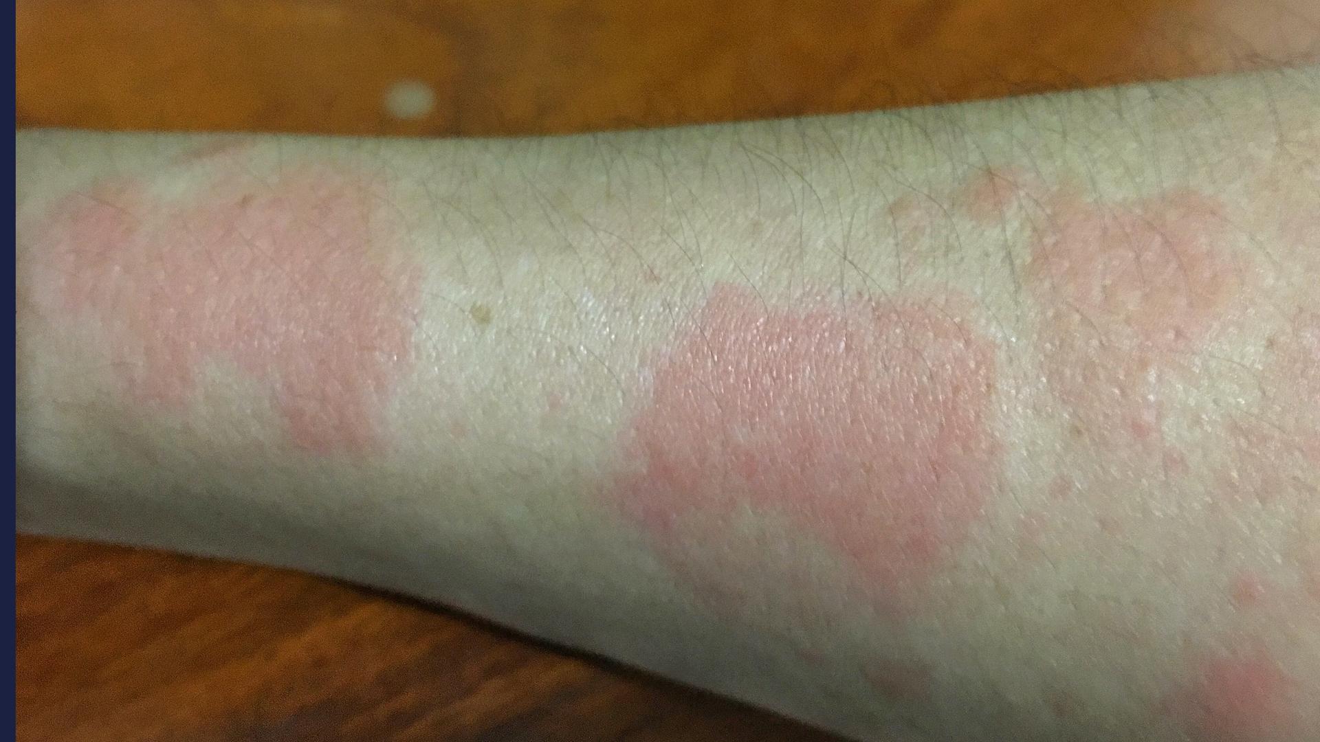 Uno de los síntomas del lupus