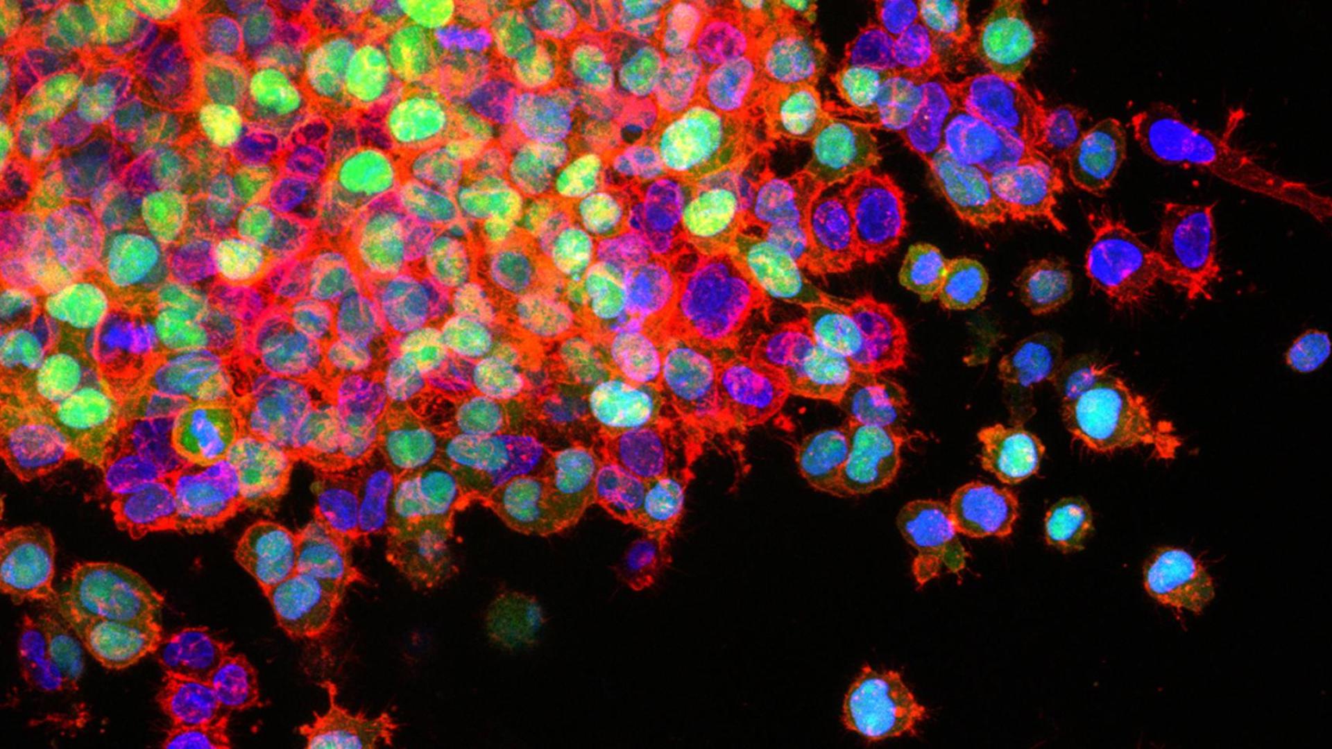 Células de cáncer de pulmón invadiendo los tejidos circundantes (metástasis)