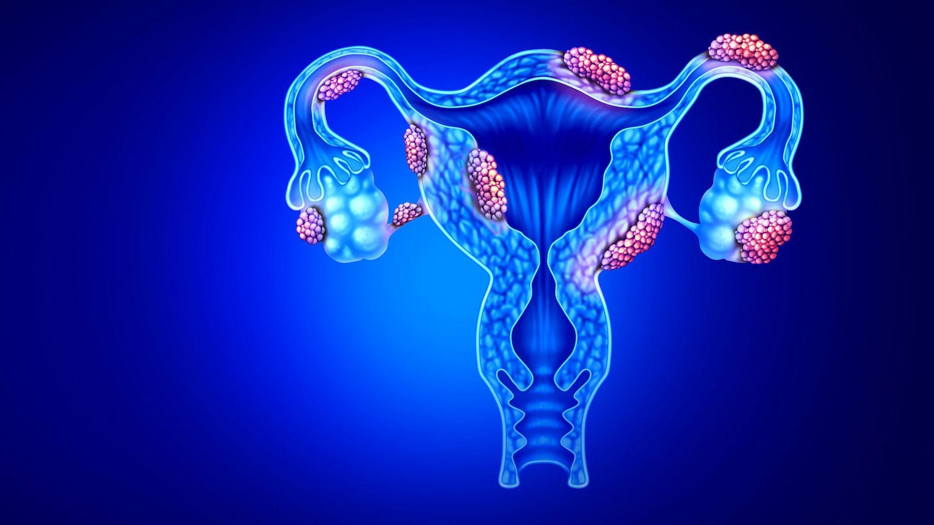 La endometriosis causa síntomas muy dolorosos