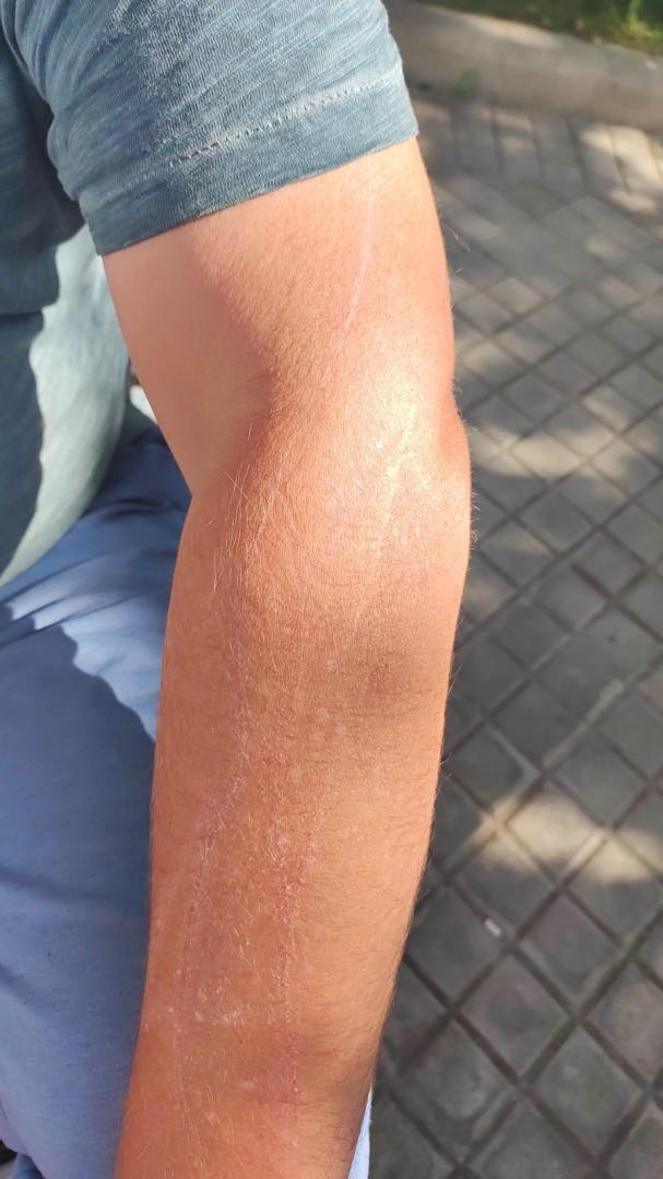 Rasguños en el brazo por la caída de la rama