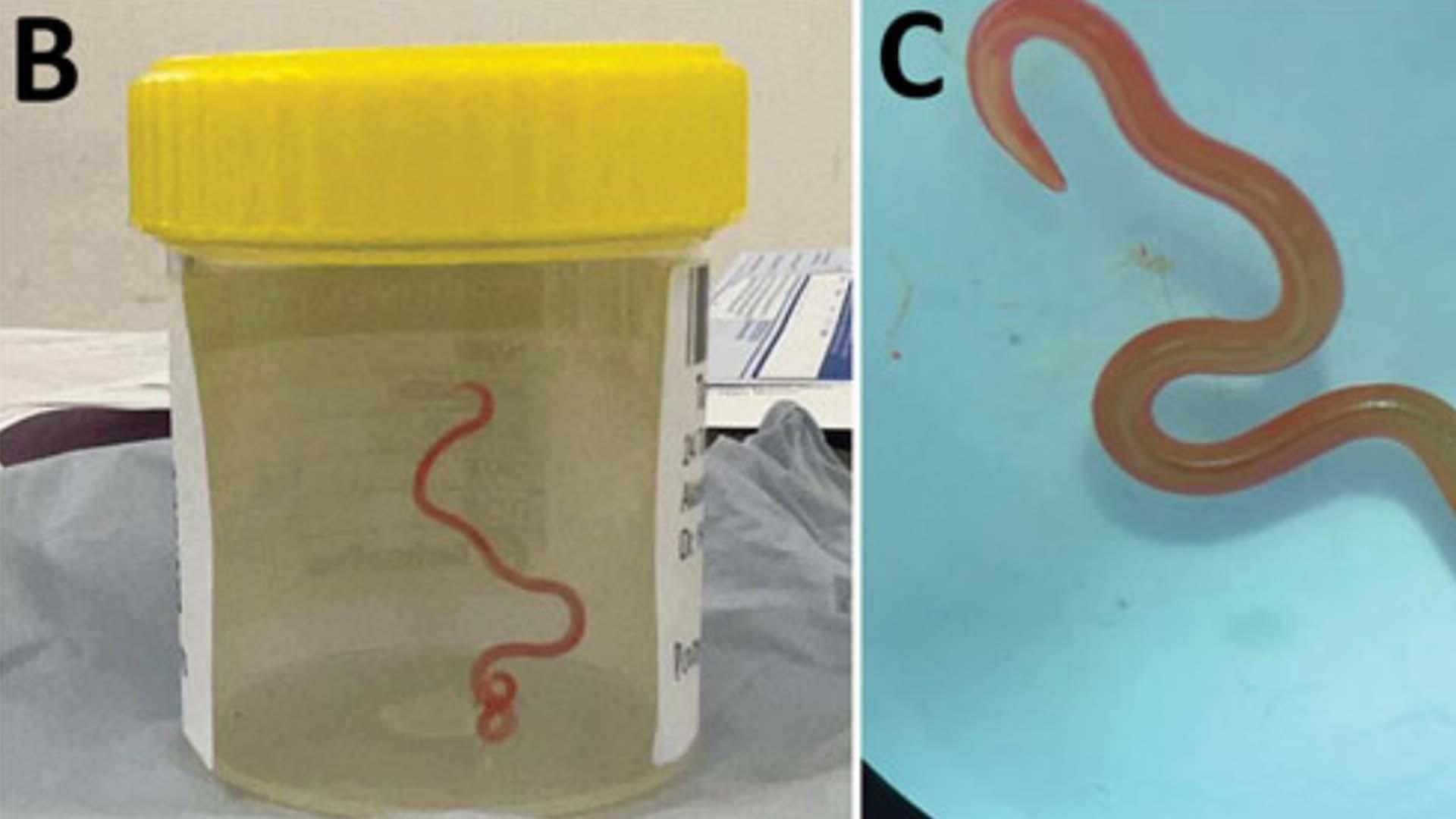 Extraen del cerebro de una australiana una lombriz intestinal viva de 8 centímetros