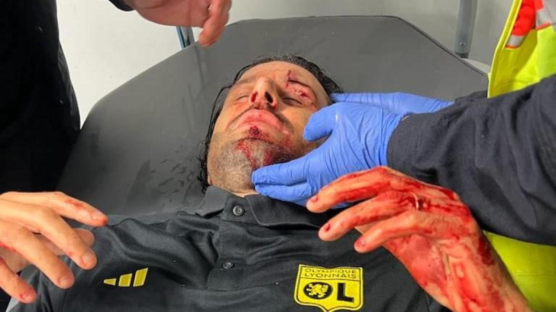 El entrenador del Olimpique de Lyon, Fabio Grosso, tuvo que ser atendido de varias heridas provocadas por la ruptura de las lunas del autobús del equipo que fue atacado por los hinchas del Olimpique de Marsella