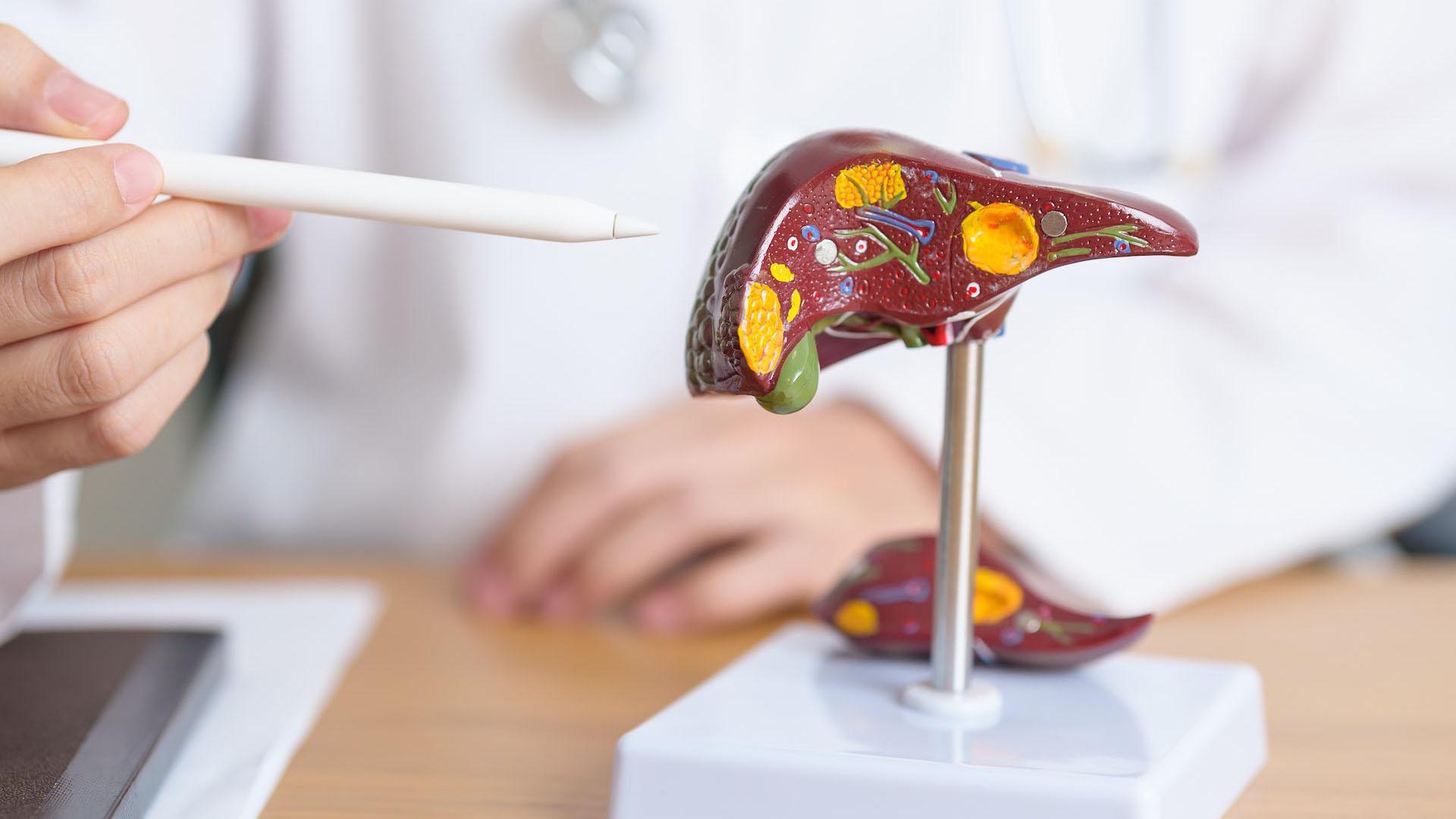 El hígado graso es la enfermedad hepática más común en nuestros días y un problema de salud reconocido.