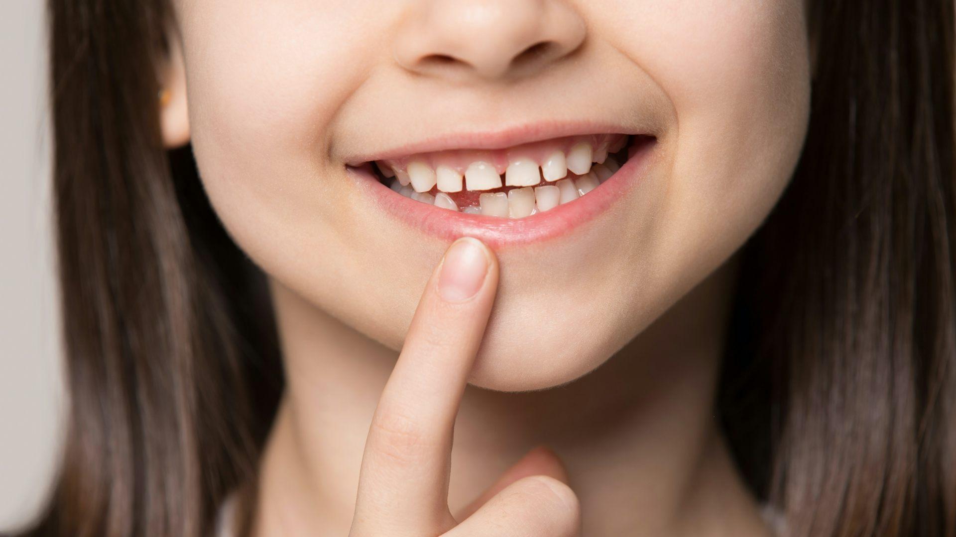 Los dientes temporales son conocidos como los famosos dientes de leche