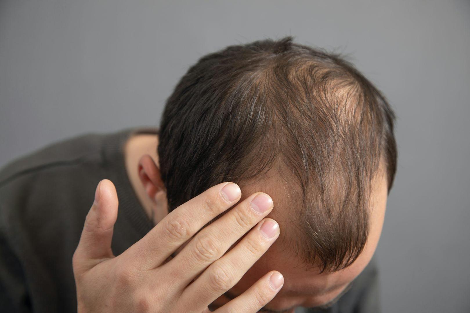 La calvicie de patrón masculino comienza a los veintitantos años.