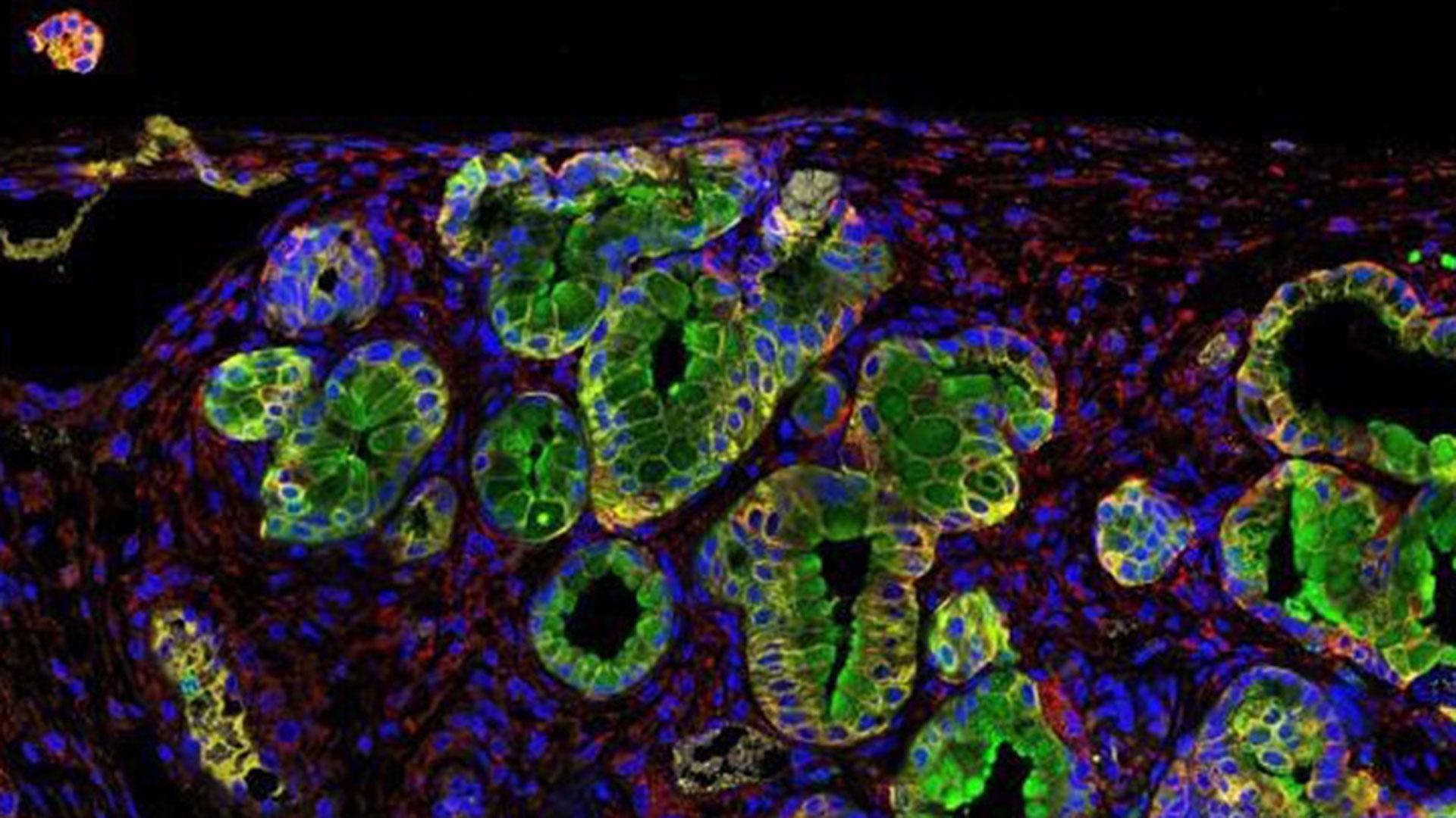 Inmunofluorescencia de un tumor de páncreas; la proteína PGLYRP1 en verde