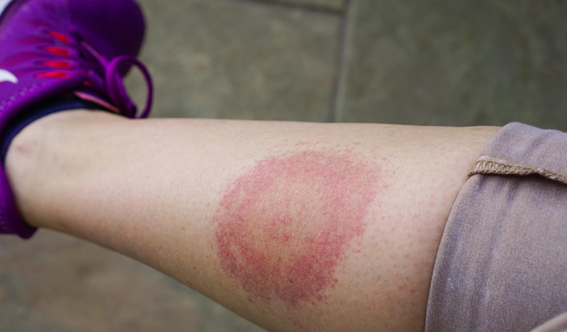 La enfermedad de Lyme es transmitida por la picadura de garrapatas infectadas