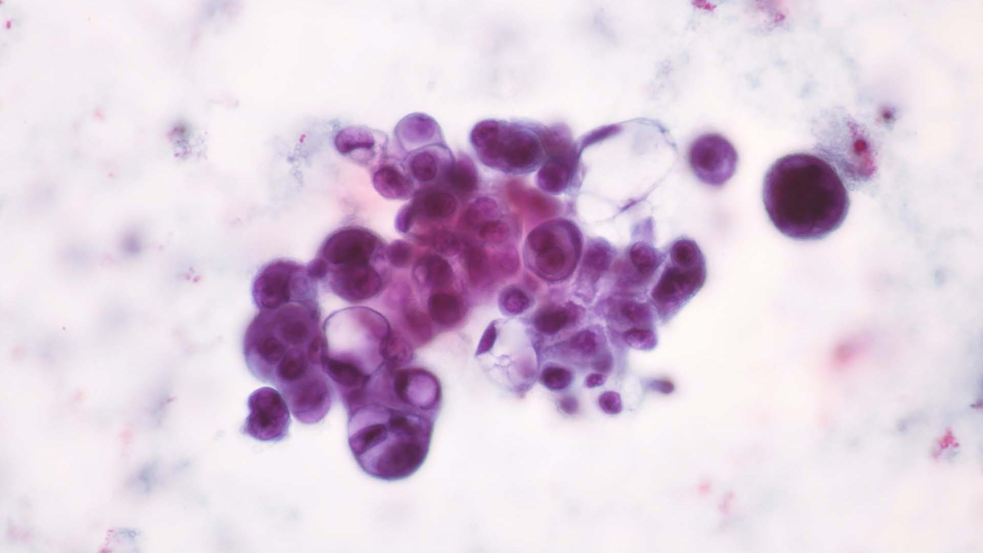 Células cancerosas