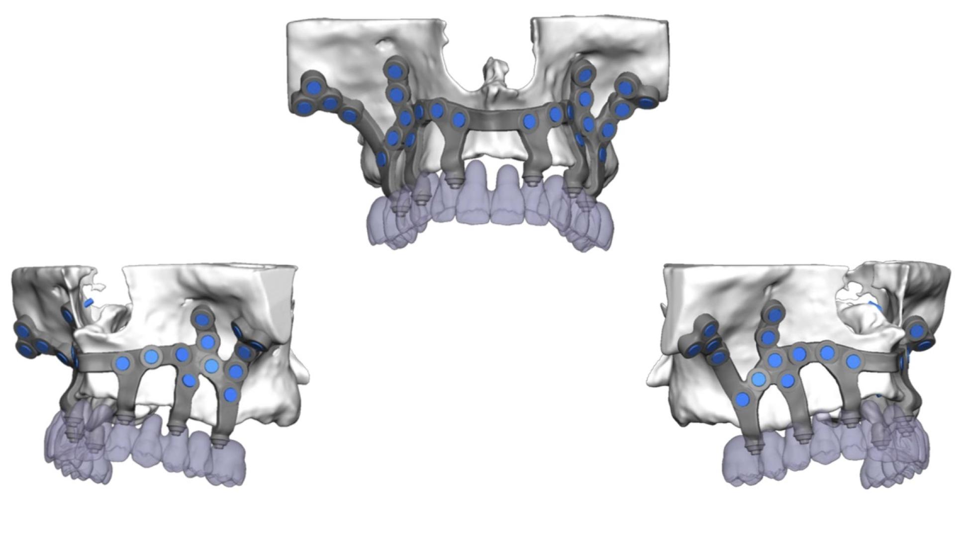 Así se colocan los implantes subperiósticos
