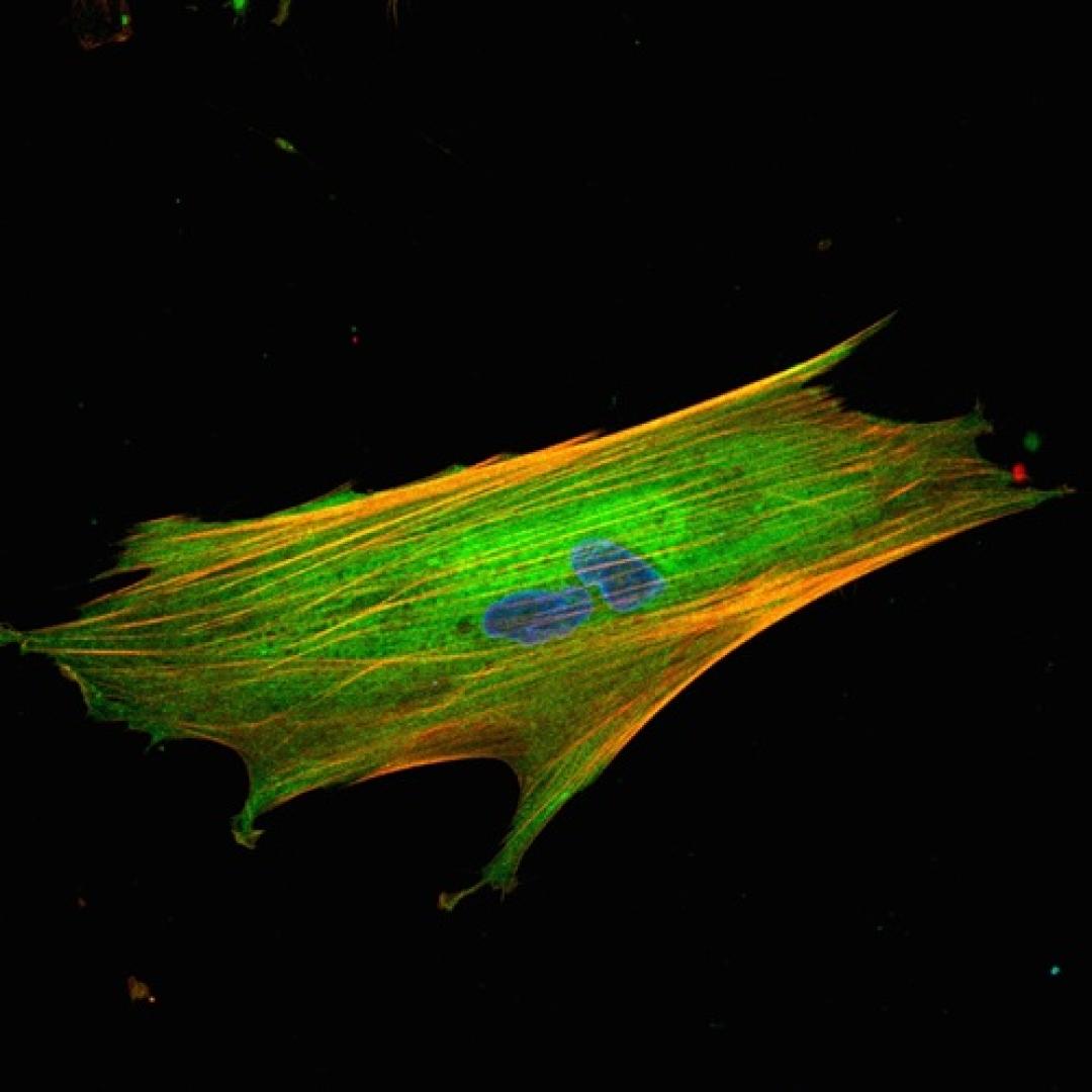 Fibroblasto asociado a cáncer