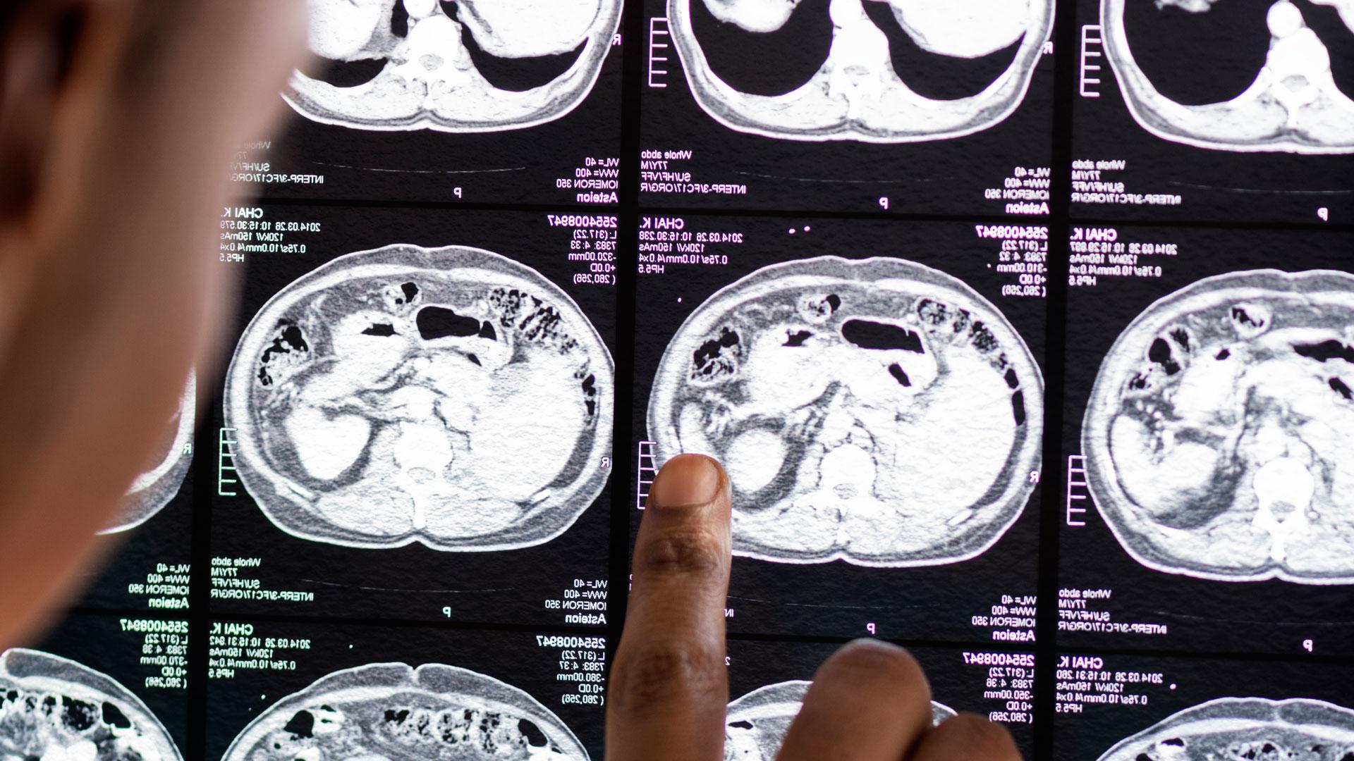 Un médico analiza el resultado de la resonancia magnética de un cerebro