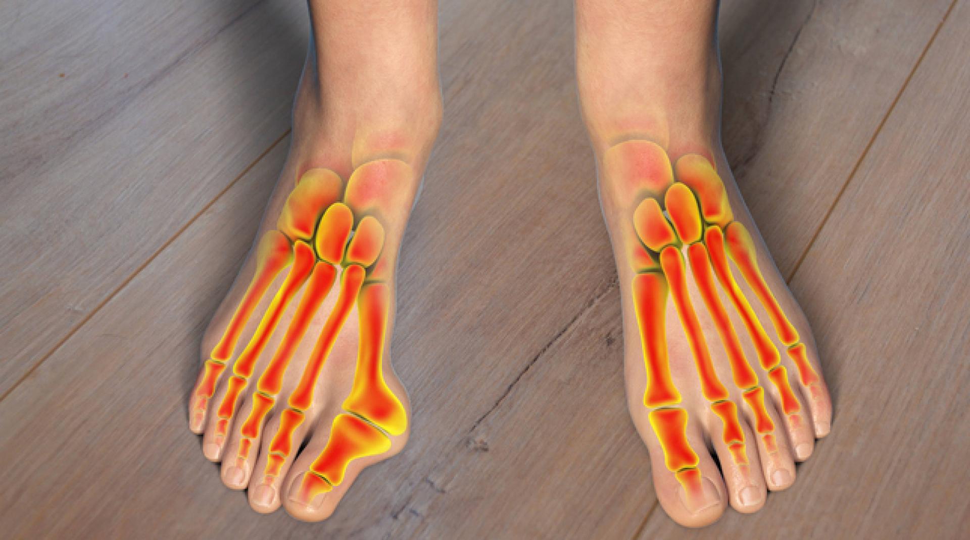 Los juanetes son una de las patologías del pie más comunes en España