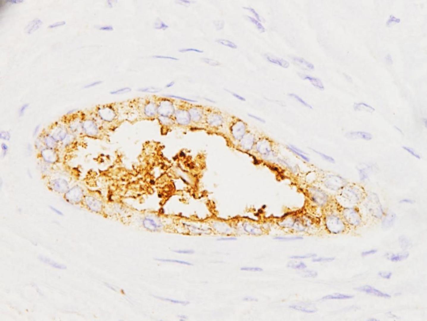 Expresión de la proteína sAXL en tumores pancreáticos