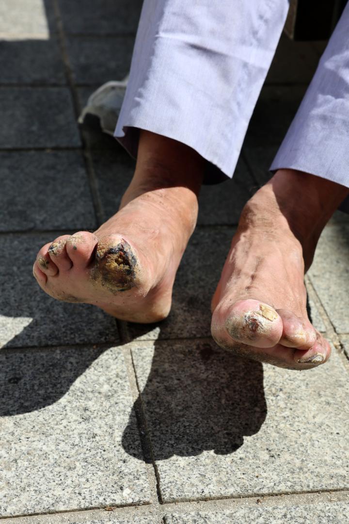 Estado de los pies de M. a finales de mayo.