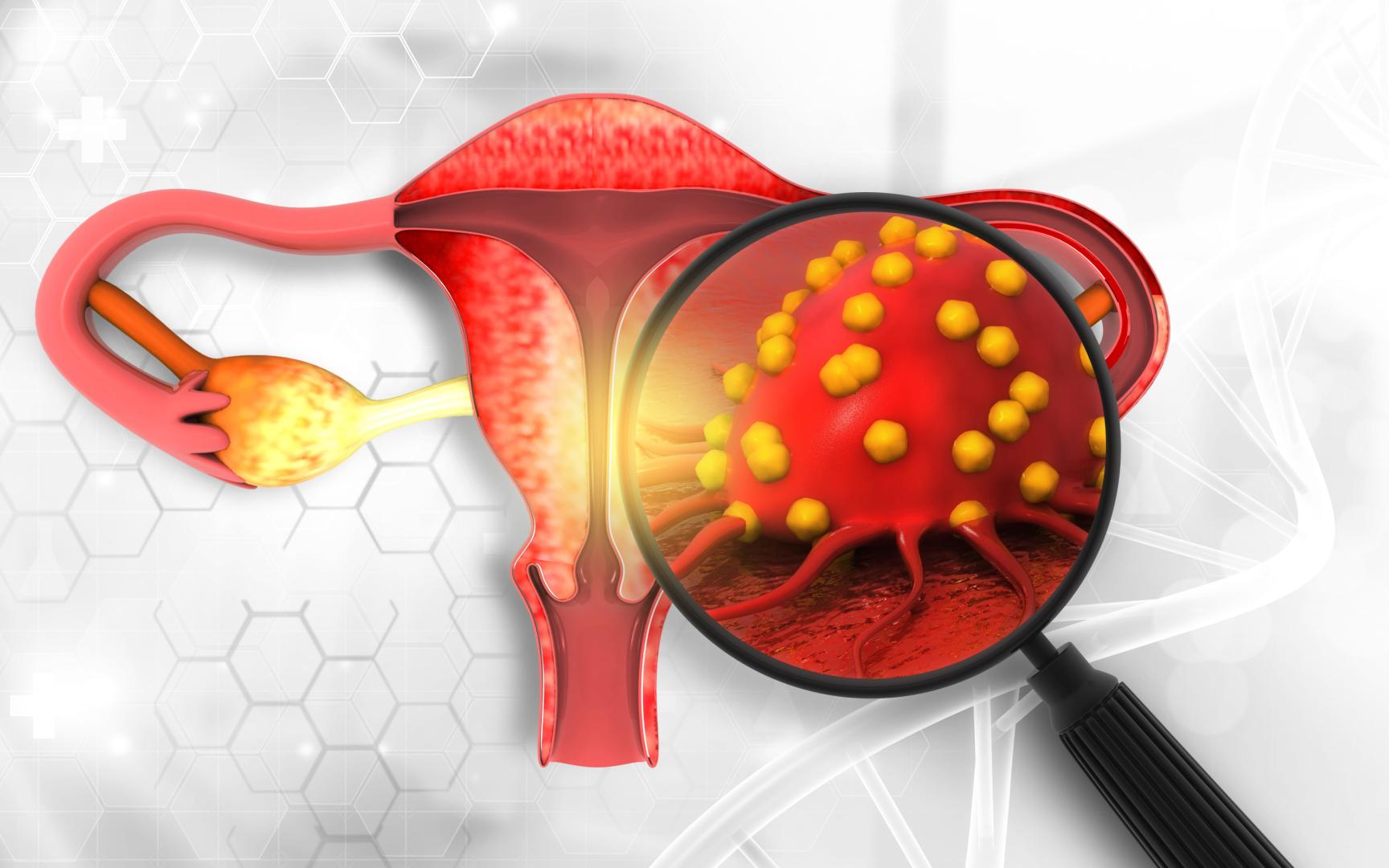 Female reproductive system diseases. Uterus cancer and endometrial malignant tumor as a uterine medical concept. 3d illustration