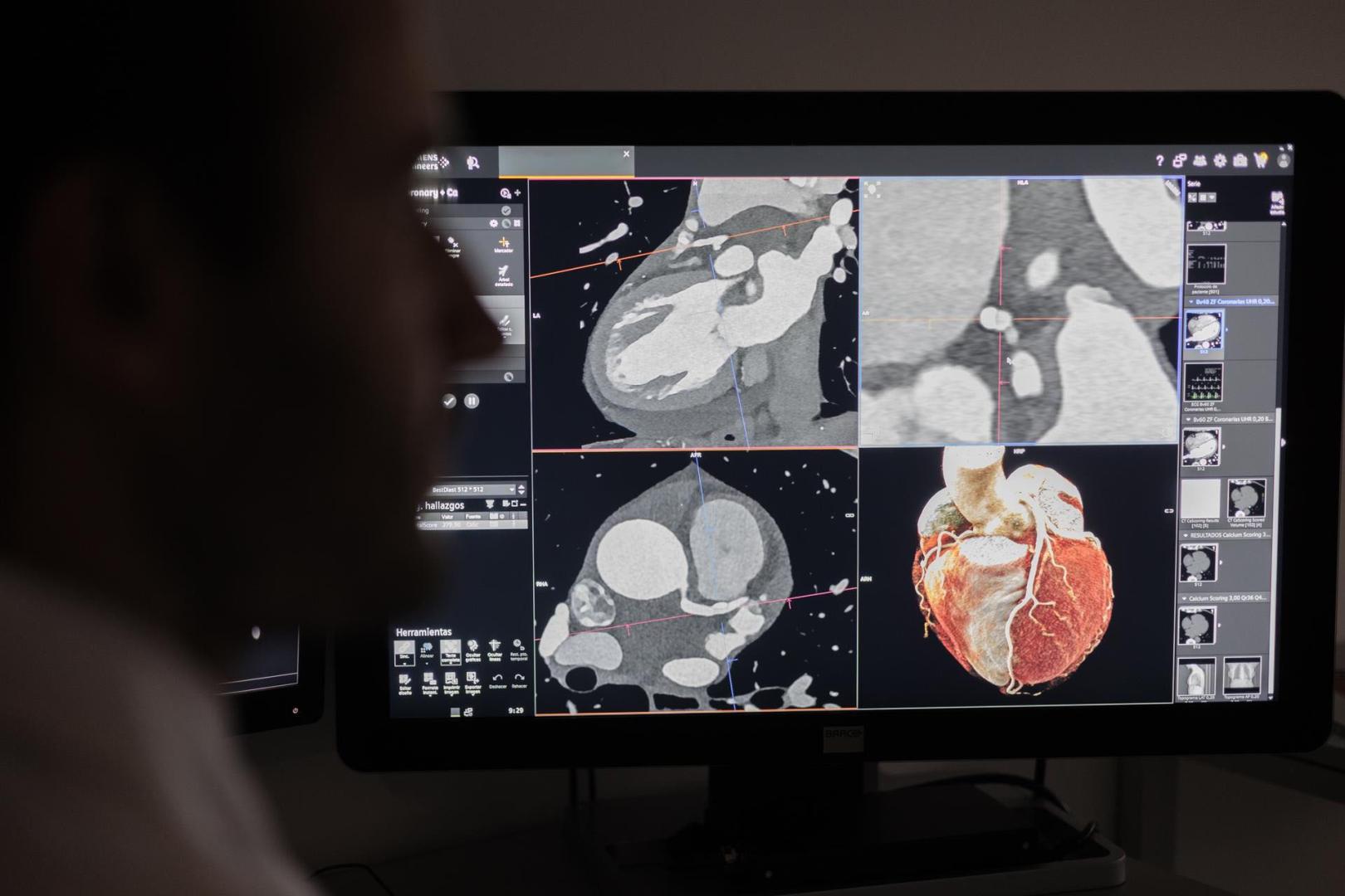 Las imágenes obtenidas con el escáner Photon Counting ofrecen mayor precisión de las arterias coronarias y de los posibles estrechamientos.