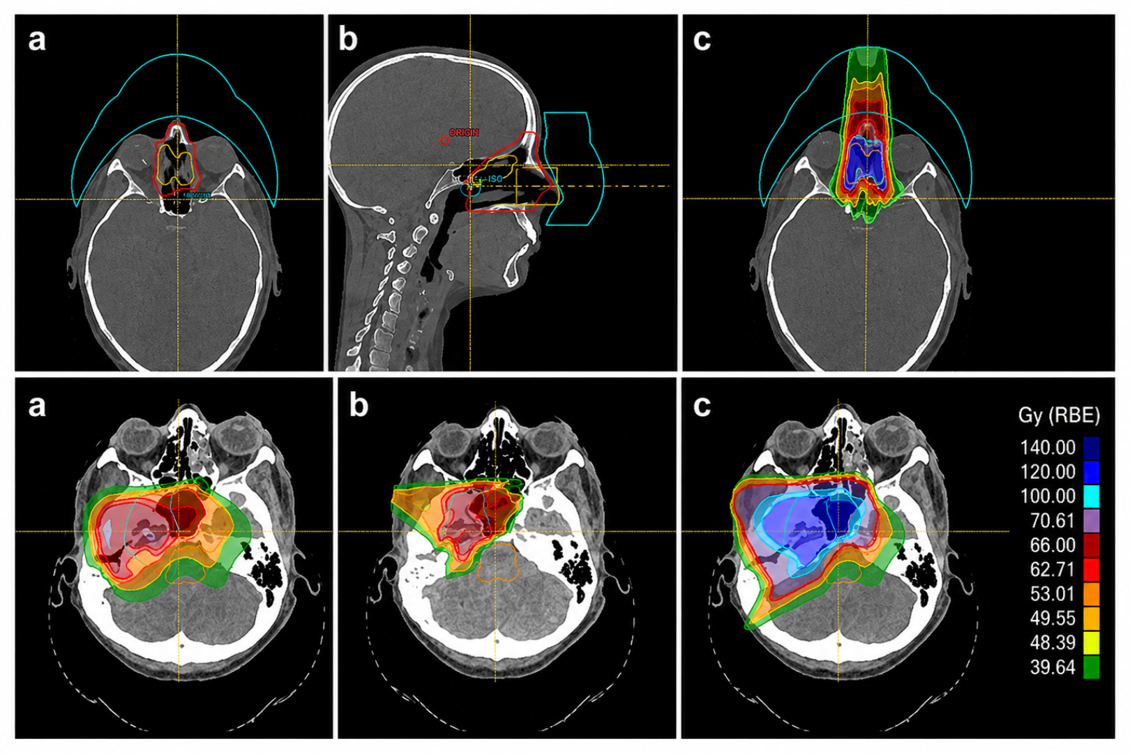 La imagen muestra cómo la protonterapia concentra la radiación en el tumor durante una reirradiación, preservando al máximo los tejidos sanos ya tratados.