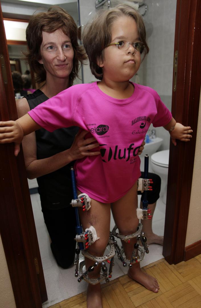 Maia Sola y su madre, Laura Garde, realizan ejercicios frente al espejo. El cuerpo de la joven ha cambiado después de la operación. / Al cumplir los 15 se sometió a elongación de huesos.