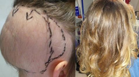Aplican por primera vez en España una técnica para combatir la alopecia grave Aplican por primera vez en España una técnica para combatir la alopecia grave