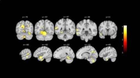Cambios en el cerebro detectados por el estudio de la Fundación Pasqual Maragall Cambios en el cerebro detectados por el estudio de la Fundación Pasqual Maragall